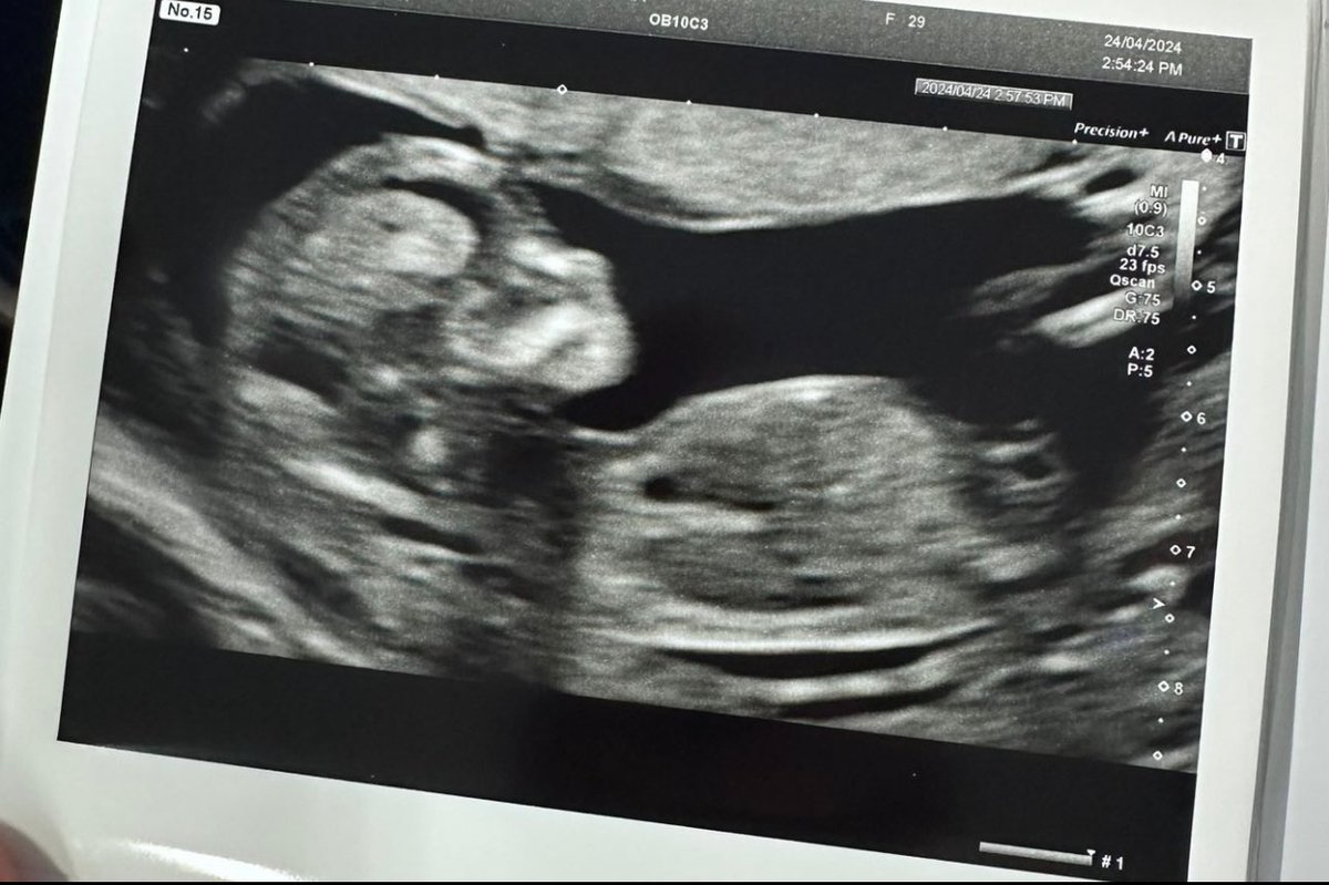 ravey88's tweet photo. Ravey66 is my Dad, I am Ravey88…

I’d like you all to meet Ravey24 due 30th October 🥰 

Mum and baby are very healthy, I think this now explains my quietness on here 🤣

We found out 2 weeks after getting the puppy as well 🤦🏼‍♂️ https://t.co/Dk6J60YZ20