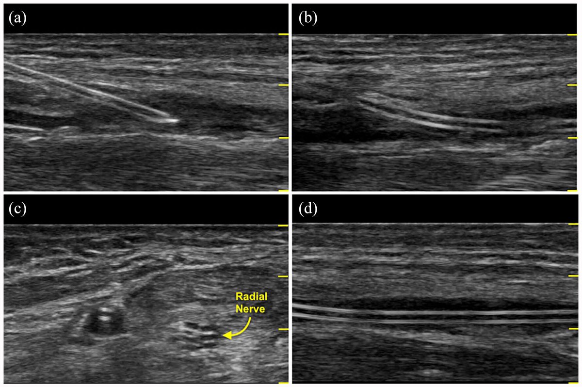 10 best practice tips for radial arterial catheterization. #POCUS #FOAMed 🔗 journals.sagepub.com/doi/10.1177/11…