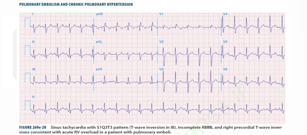 El patrón electrocardiográfico más especifico de tromboembolia pulmonar (TEP) es el patrón S1Q3T3 o también llamado 'complejo de McGinn-White. Aunque tampoco es exclusivo de TEP. Harrison 19th ed