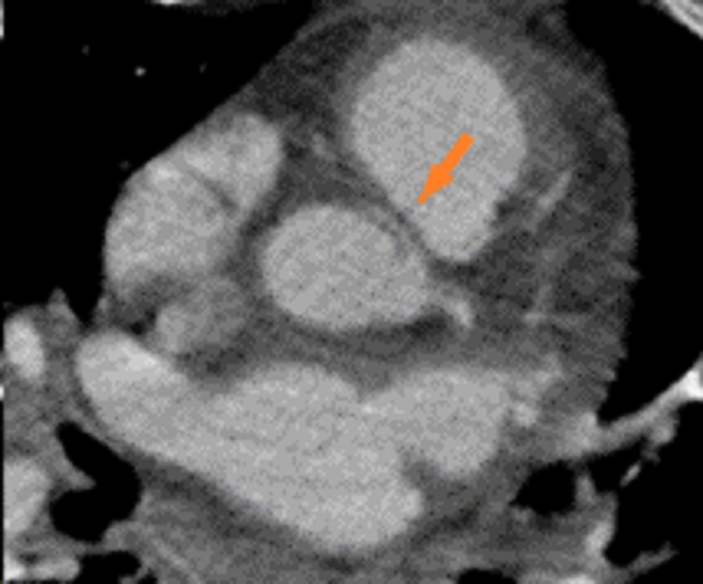 👨48 yo male w/ asthma & HTN w/ CP & weakness in limbs ⚡️ECG w/ NSTEMI 💉Trop ↑, WBC 19K, 29% eos, IgE↑, CRP↑ #echofirst LVEF 35% & effusion ☢️Cath cor angio → no obstruction w/ AAORCA ☢️CT → bil pleural effusion & lymph nodes 2/5 #WhyCMR #SCMRCases @SCMRorg