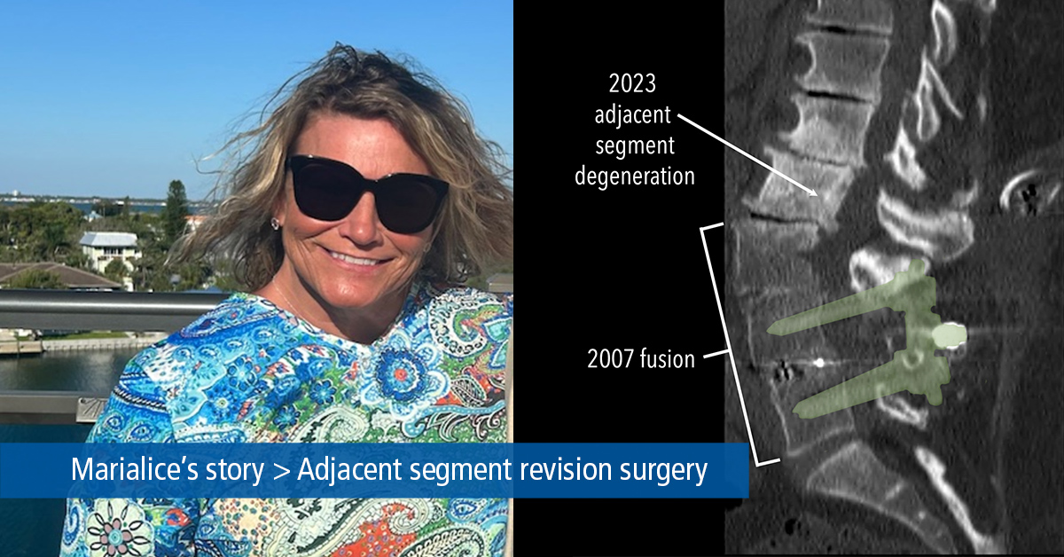 Marialice's first spine surgery in 2007 fused three vertebrae together in her lower back. The latest came in 2023, when Dr. Zachary Plummer repaired the levels directly above the previous fusion. Read Marialice's story. bit.ly/Hope_Marialice #mayfieldhopestory #spinecare