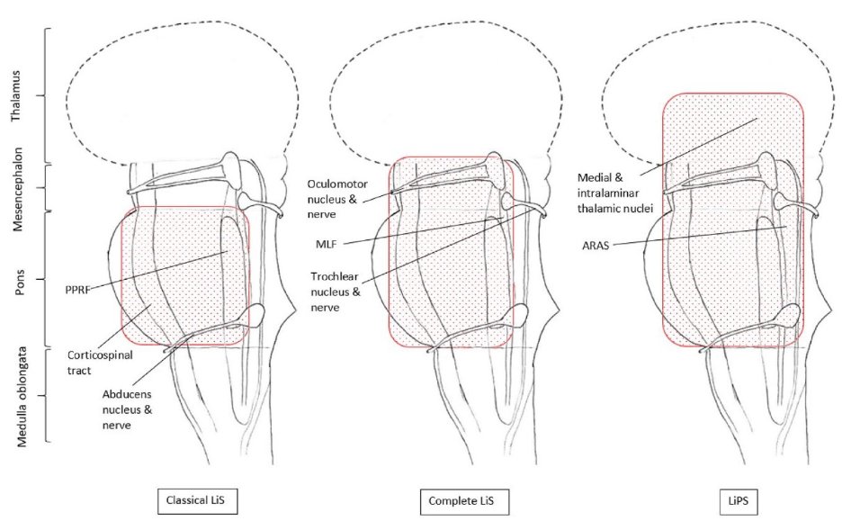 Another Editor's pick: This is a must-read Review on locked-in syndrome! Here, Laura Schnetzer and colleagues discuss differential diagnosis and different types of locked-in syndromes, and highlight important topics related to quality of life. journals.sagepub.com/doi/full/10.11…🔓