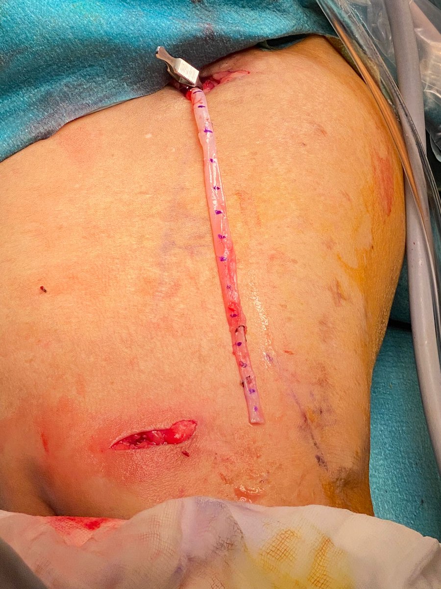 Endoscopic single stage brachiobasilic AVF creation negates the need for a long incision and potentially reduces wound complications #dialysisaccess #vascular #vascularsurgery #iRAD #surgery