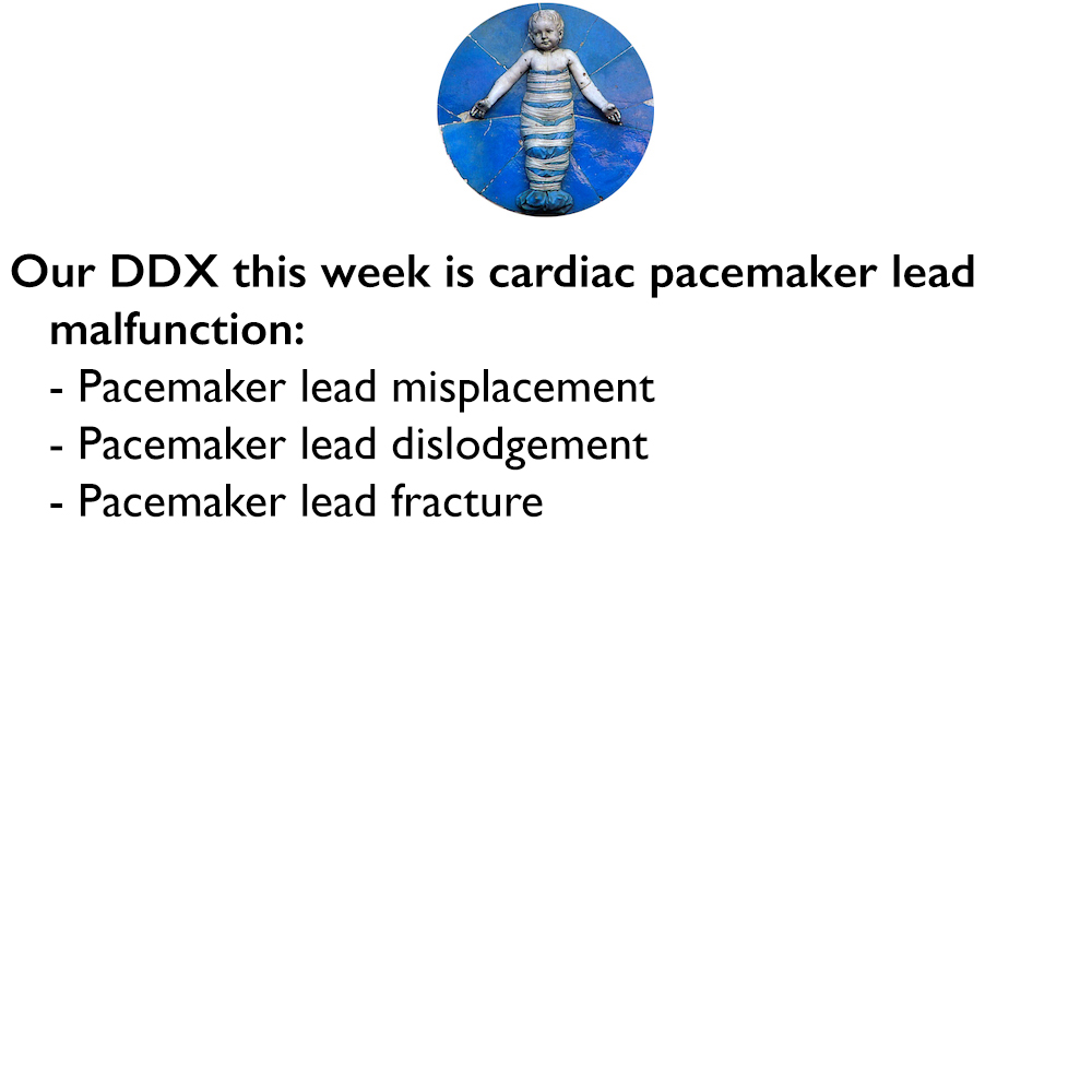 Our differential diagnosis this week is cardiac pacemaker lead malfunction:
- Pacemaker lead misplacement
- Pacemaker lead dislodgement
- Pacemaker lead fracture

Learn more: pediatricimaging.org/ddx/differenti…

#FOAMed #FOAMPed #FOAMRad #MedEd #PedsRad #RadEd #RadRes #radiology