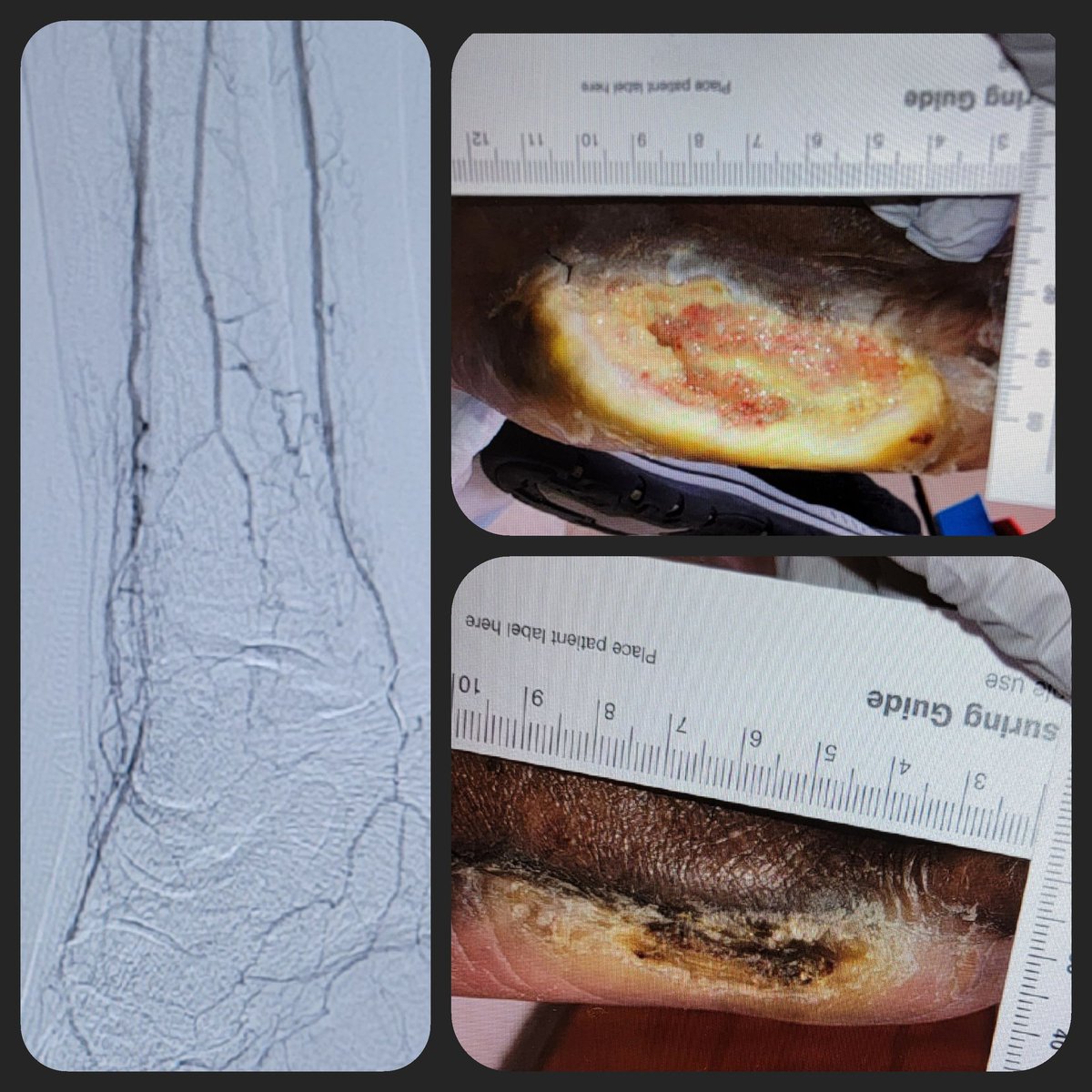 Expertise in #CLI does not end in hi-fives in the control room after successful three vessel run off, but with longitudinal patient follow up, personalized wound care and multi-D collaboration, until complete wound healing is achieved and amputation is prevented. #VIrad #PAD