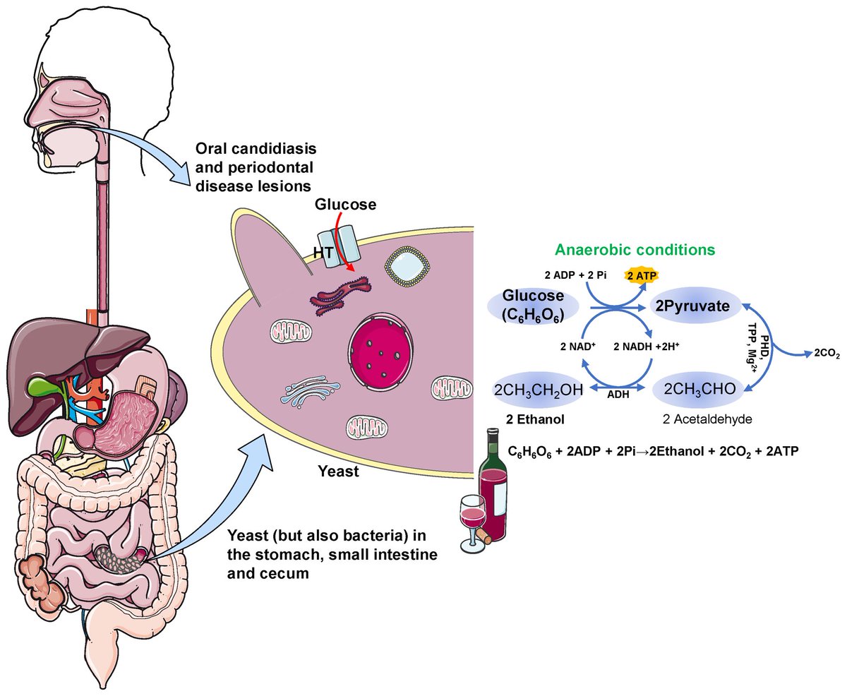 In the news recently, auto-brewery syndrome involves gut microbe fermentation of a high carb meal to ethanol. Systemic absorption can lead to true intoxication. The person literally makes their OWN alcohol 🤯