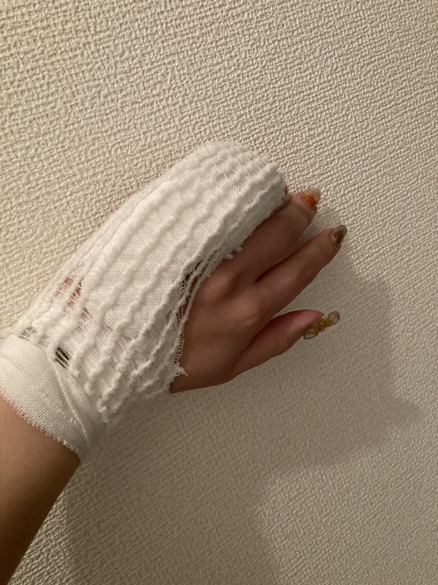 sorataro0502's tweet photo. 骨折したんってくらい頑丈に固定されたんだけどwww
重度の打撲(？)でしたwwwwww
炎症酷かったのと指曲がらんからってのでこんなされたwwwwww https://t.co/BJDJ4rJP4c