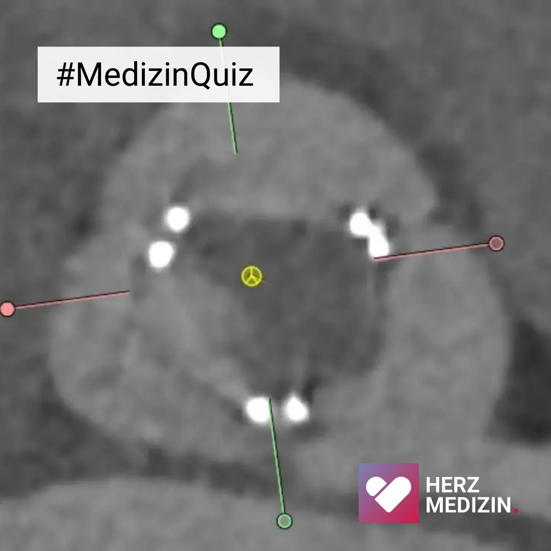 🔍Bereit, Ihre Diagnosefähigkeiten zu testen? Unser Medizin-Quiz präsentiert Fälle aus der kardialen Bildgebung: 👉 herzmedizin.de/fuer-aerzte-un… #Herzmedizinde #DGK #BNK #Kardiologie #Diagnose #Medizinquiz #Expertenwissen