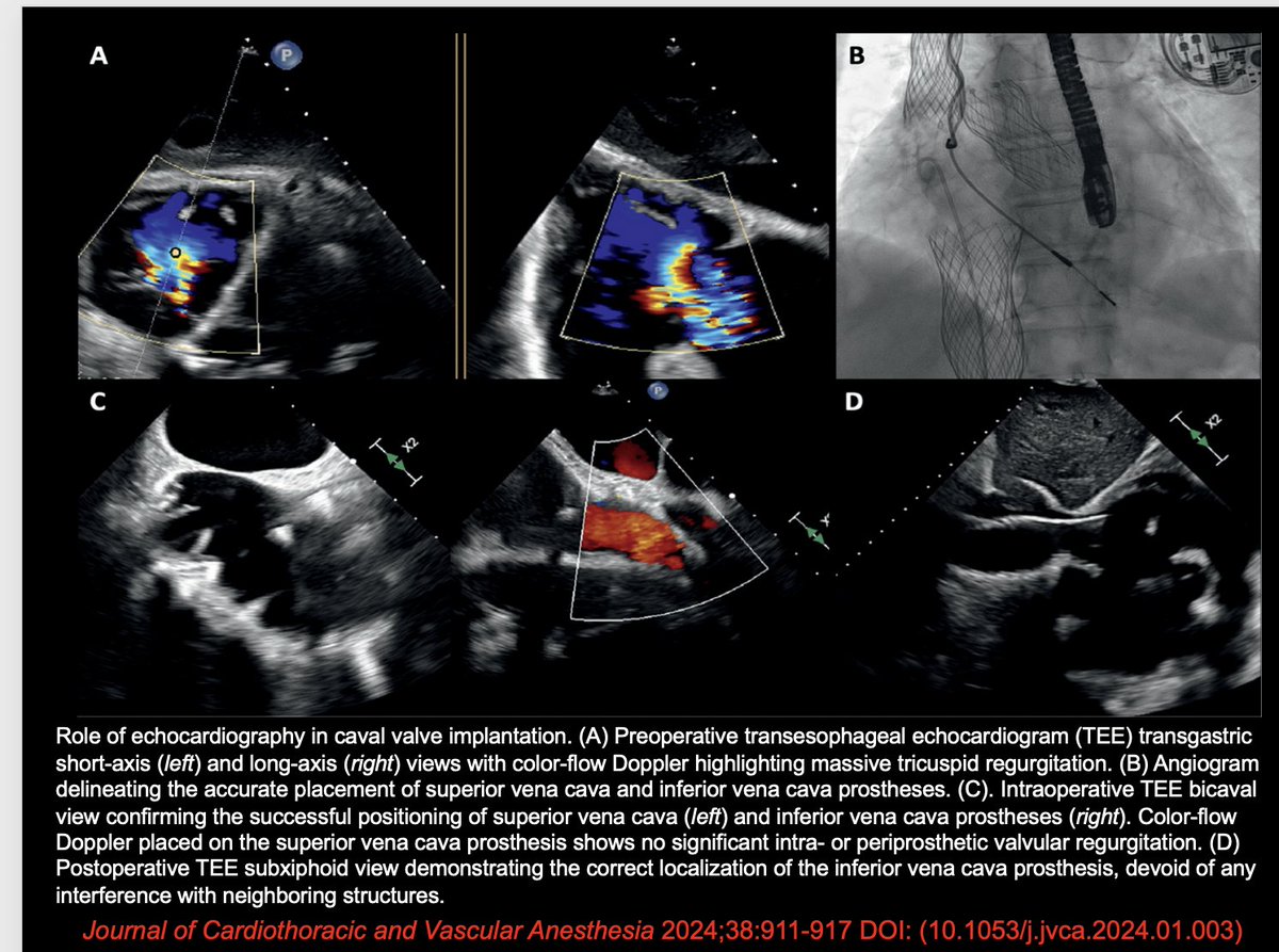 Caval valve implantation (#CAVI) represents a minimally invasive strategy for managing severe #tricuspid regurgitation in high-risk patients unsuitable for surgical or transcatheter tricuspid valve implantation. jcvaonline.com/article/S1053-…