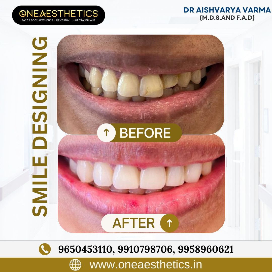 Smile transformation! Rediscover your confidence with our smile design expertise.

For more info
Visit the Website oneaesthetics.in
Call @096504 53110

#oneaesthetics #dental #dermatologist #plasticsurgeon #draishvaryavarma #dentalcare #smiledesign #cosmeticdentistry