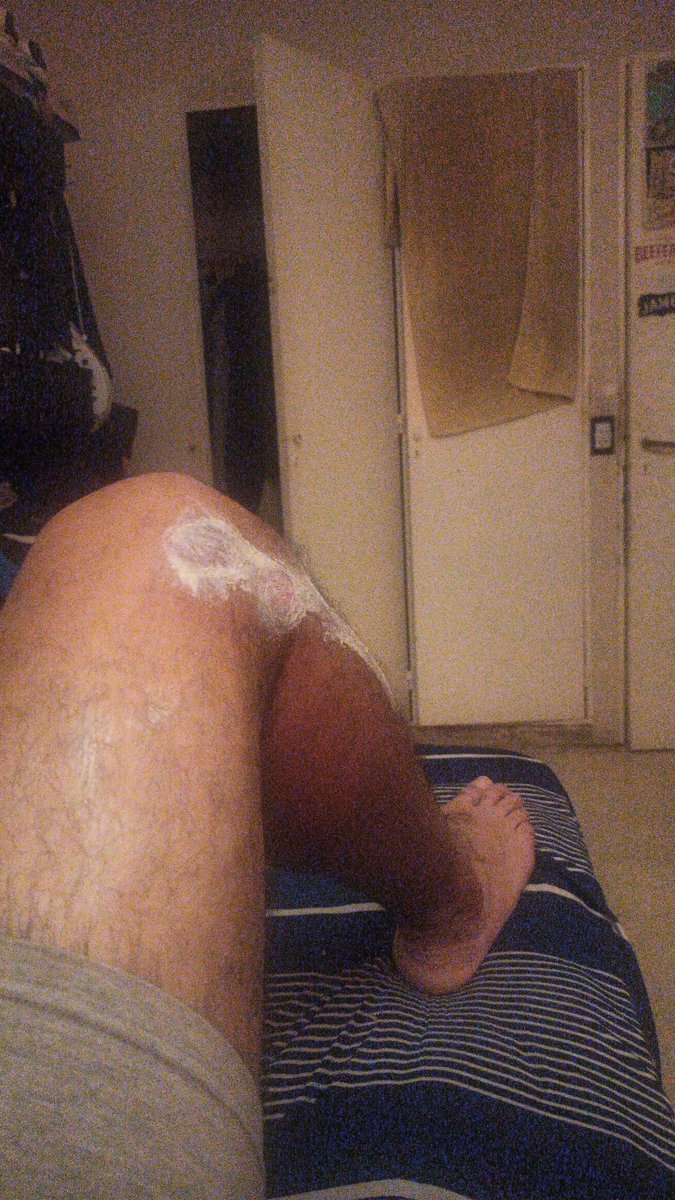 olunar_1975's tweet photo. @nadiedicenada_ buen diaaaa desde la cama porrazo en moto 1 am. Me inmole por perruno ......gracias por siempre estar son todo lo que esta bien!!!! https://t.co/R76NwCLUiX