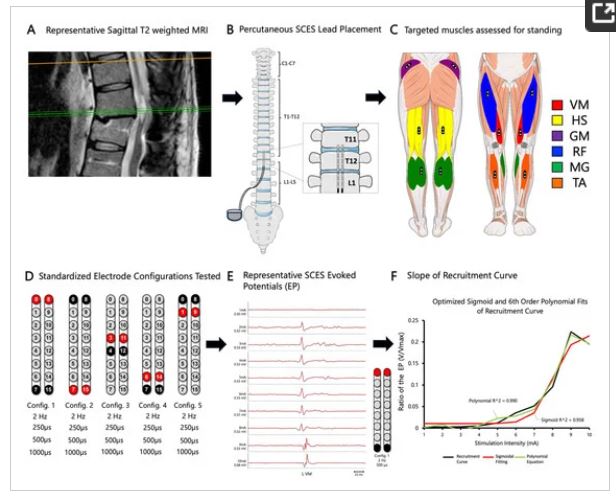 #Newpub in @JCM_MDPI by @CUPhysMed faculty @DrAndrewCSmith & team on Peak Slope Ratio of the Recruitment Curves Compared to #Muscle Evoked Potentials to Optimize Standing Configurations w Percutaneous #Epidural Stimulation after #SpinalCordInjury. mdpi.com/2077-0383/13/5…