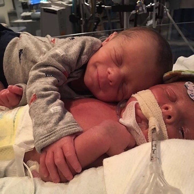 Yoğun bakımda tedavi gören ikiz kardeşini hiç yalnız bırakmayan koca yürekli bebek 👼❤️