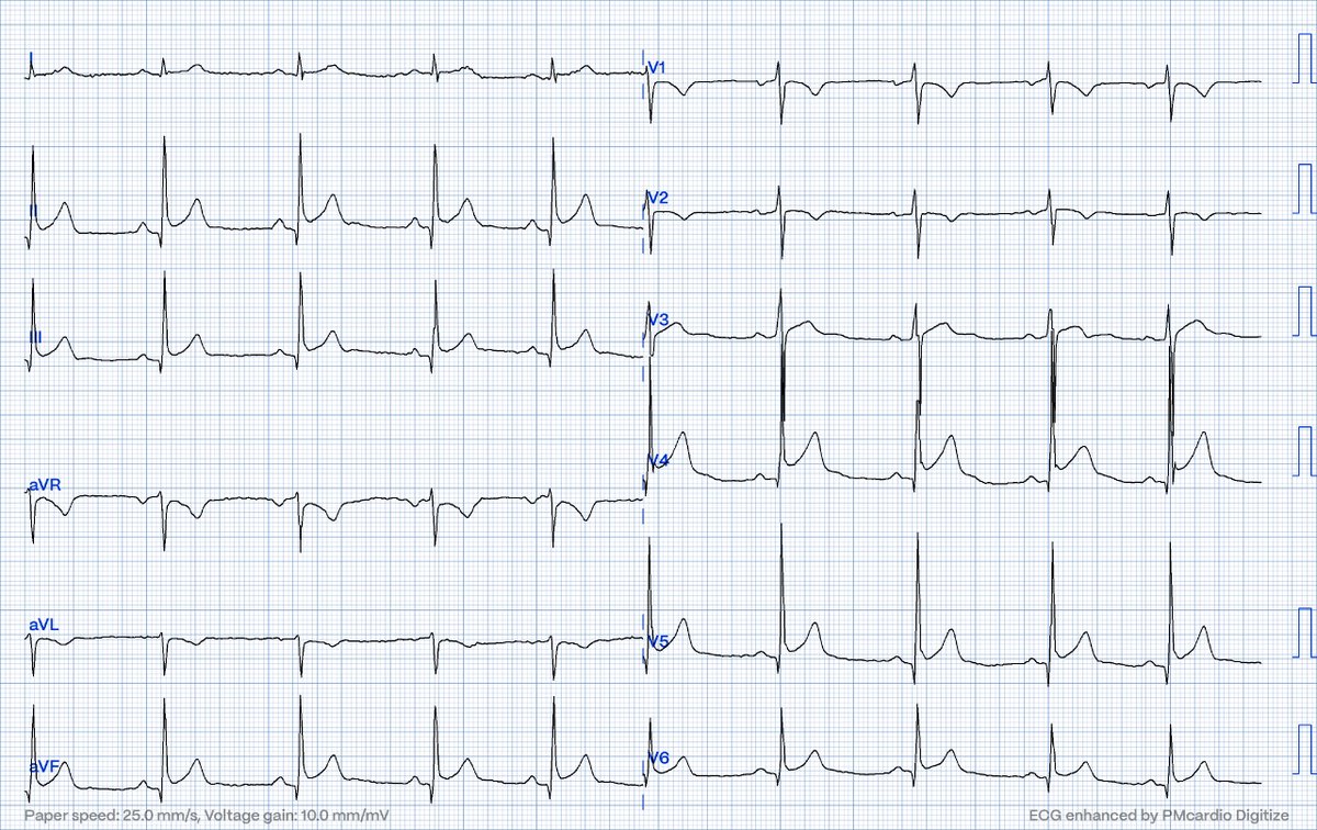 Take the OMI Quiz and Test yourself against the Queen of Hearts Go to the blog post for the link to the Quiz: hqmeded-ecg.blogspot.com/2024/04/take-o… Here is the first of the 27 EKGs in the Quiz