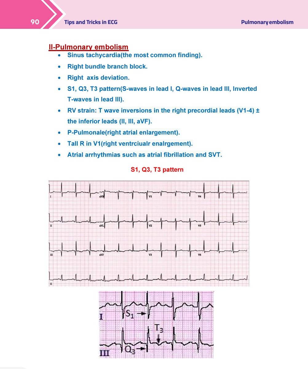 'ECG signs in patients with pulmonary embolism' From my book 'Tips and Tricks in ECG'