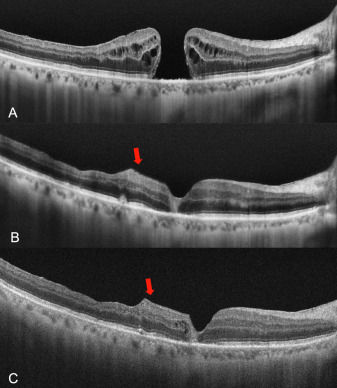 In this surgical technique, a Descemet membrane graft was used as a scaffold to promote the closure of a full-thickness macular hole ow.ly/cPOF50QYVb0