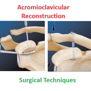 AcromioClavicular Joint Reconstruction 
youtube.com/playlist?list=…

#orthotwitter #orthopaedicprinciples