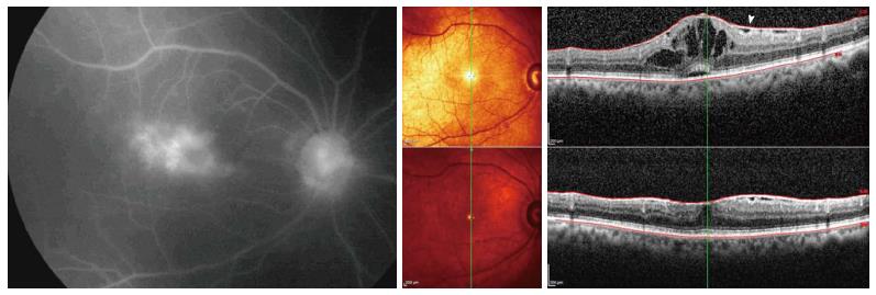 Meta-analysis Demonstrates Effective, Safe Treatment for Uveitic Macular Edema

The noninfectious form was helped by periocular and intraocular corticosteroids. Newer delivery methods have less evidence supporting their use.
reviewofoptometry.com/article/metaan…
#macularedema #uveitis