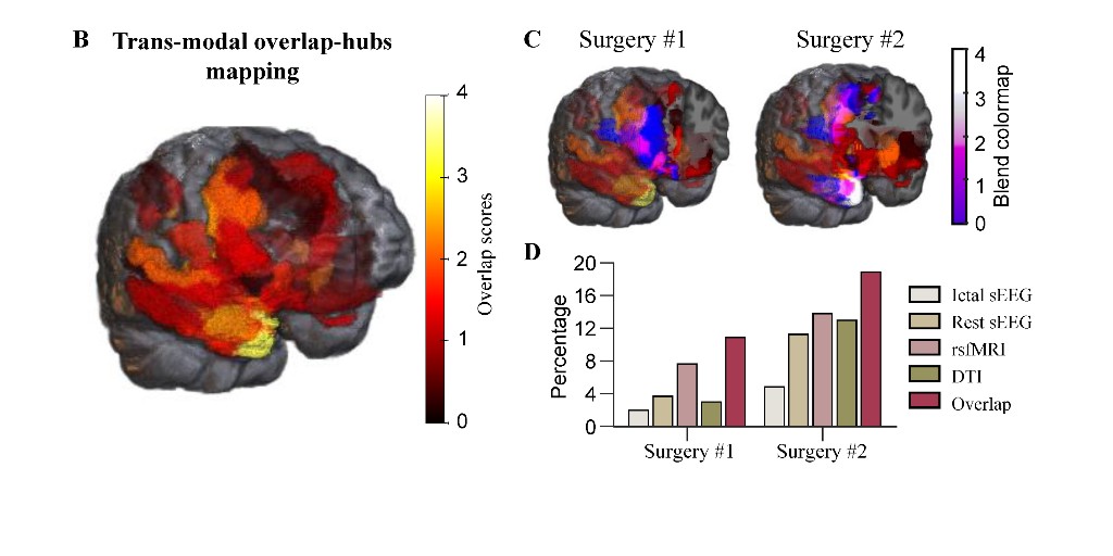 @GongRuxue and colleagues at @EmoryMedicine @ZuckerSoM @UofSCSOMC provide a proof of concept article on the utility of multimodal neurophysiology and neuroimaging integration in patients with #epilepsy undergoing #epilepsysurgery. Available at: bit.ly/3vVjtLi @ACNS_org