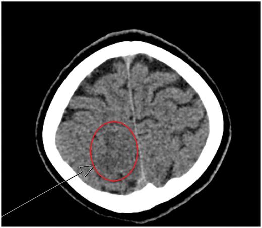 #PediatricsInReview | New-Onset Hypertension and Seizures in a 10-year-old Girl with Cyclic Vomiting Syndrome: bit.ly/43NKXit
