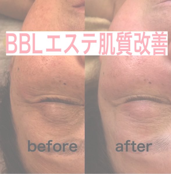 hairsRIPPER's tweet photo. 肌質改善
BBLアンチエイジングケア https://t.co/jxeG8erkqm