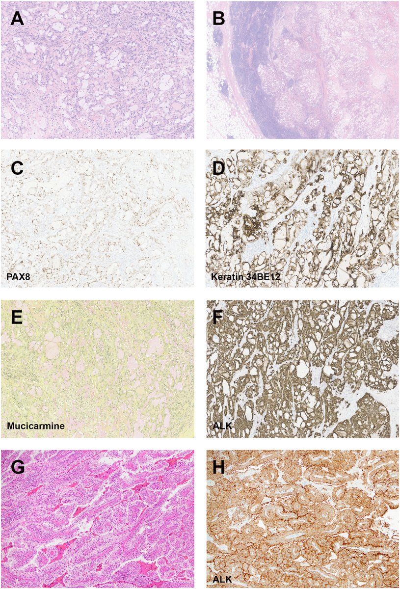 New in #HumPathol: ALK-Rearranged Renal Cell Carcinoma with Nuclear Mitotic Apparatus Protein 1 (NUMA1) as a Fusion Partner. sciencedirect.com/science/articl… #pathology #PathTwitter #PathX #GUpath