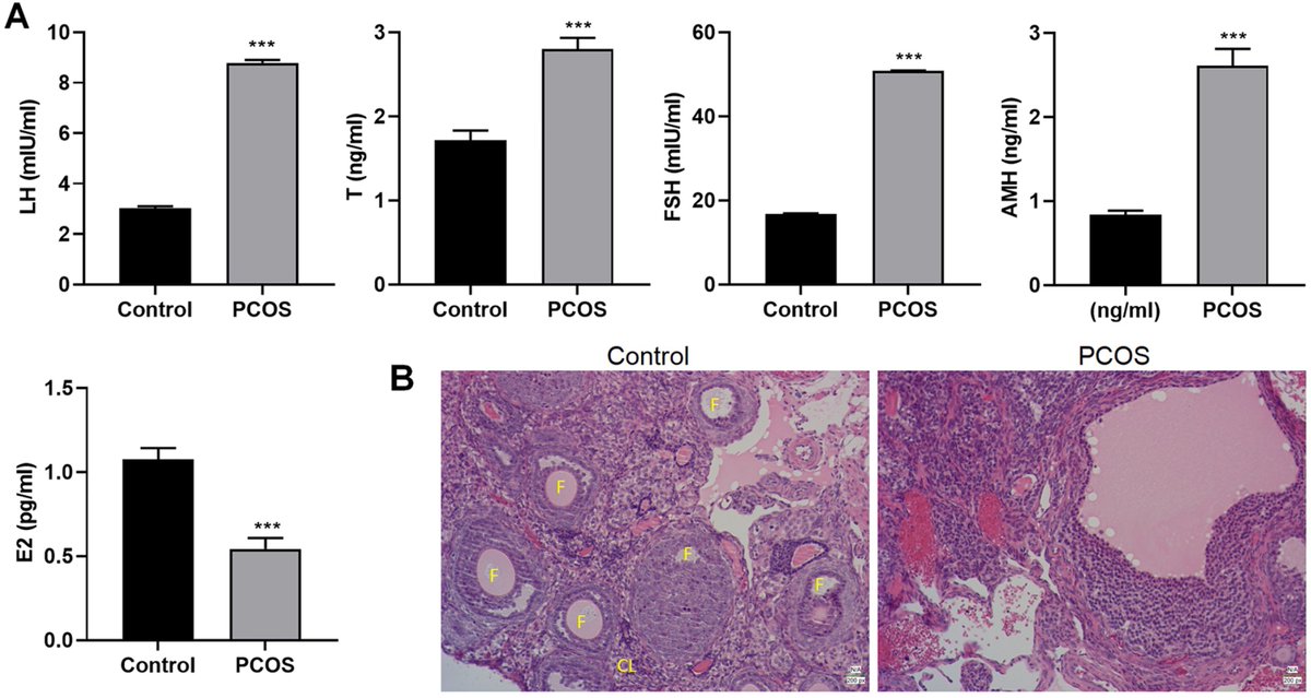Protocatechuic acid alleviates polycystic ovary syndrome symptoms in mice by PI3K signaling in granulosa cells to relieve ROS pressure and apoptosis. @tandfonline 
Gynecological endocrinology : the official journal of the International Society of Gynecological Endocrinology…