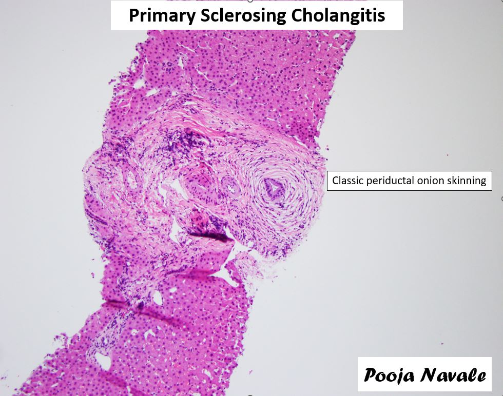 Some cases are so classic that I am tempted to post just one image! See, liver pathology is not so bad after all