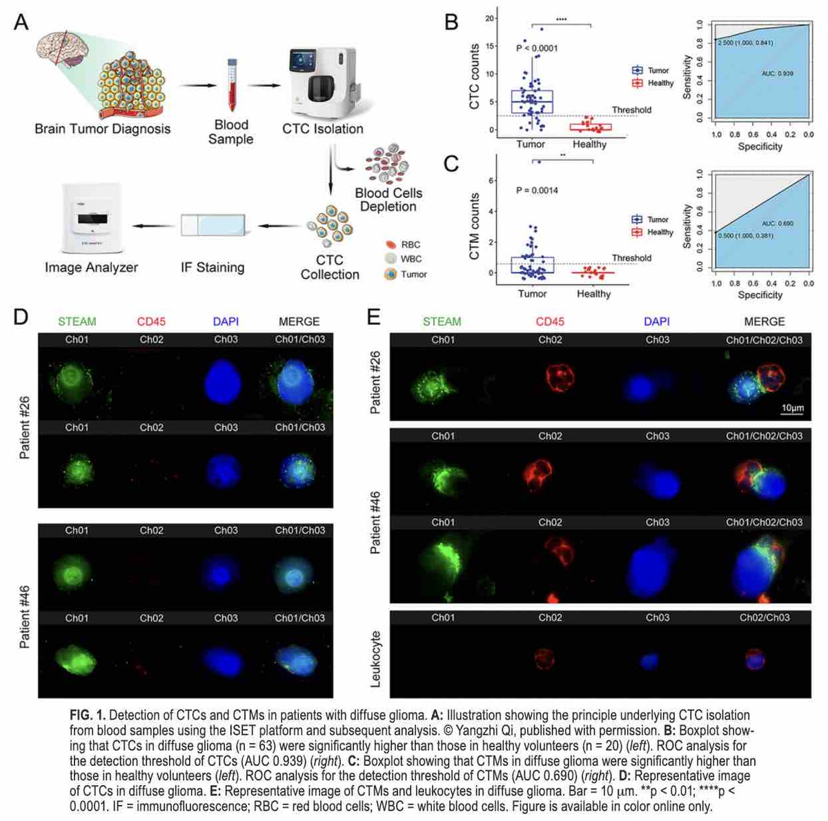 #OnlineFirst: Use of circulating tumor cells and microemboli to predict diagnosis and prognosis in diffuse glioma. thejns.org/view/journals/….