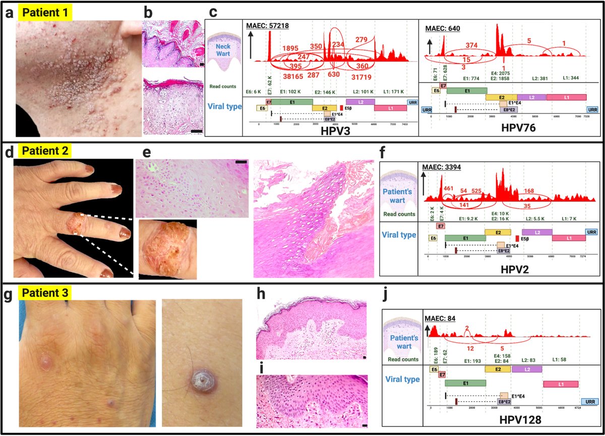 Novel whole #transcriptomesequencing as a new tool to identify viral infections in patients with #immunodeficiencies ow.ly/TJRJ50RlkBs #dermtwitter #medderm