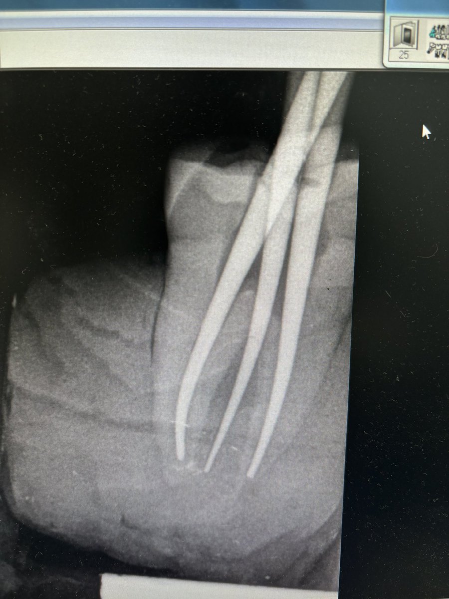 My first molar case in endodontics
It’s C shaped canal 🔥🔥: