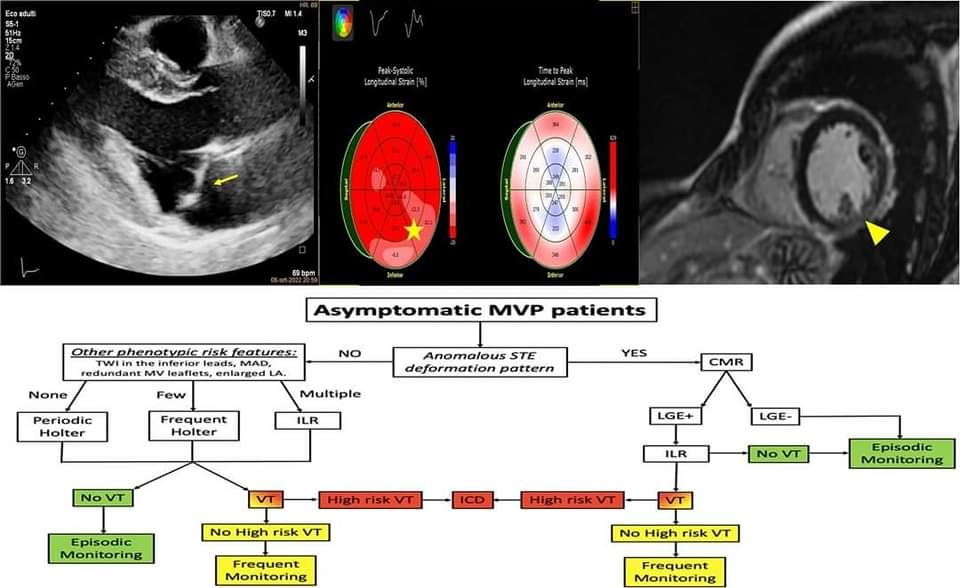 🔴 Arrhythmic mitral valve prolapse: a practical approach for asymptomatic patients

academic.oup.com/ehjcimaging/ar…
#CardioEd #CardioTwitter #cardiology #meded