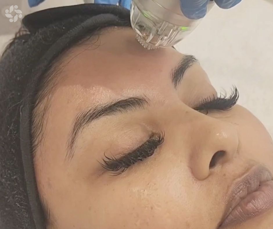 SkinBodyRenewal's tweet photo. RF Needling targets fine lines, sagging skin, and uneven texture, stimulating collagen production for long-lasting results https://t.co/TaavKnWl8O
#SkinRenewalSA #CelebritySkin #skin #skincare #RFNeedling #CelebSkinSecret #RFNeedlingGlow #ThembiSeete #YouthfulRadiance https://t.co/S7aFDnR3Ht