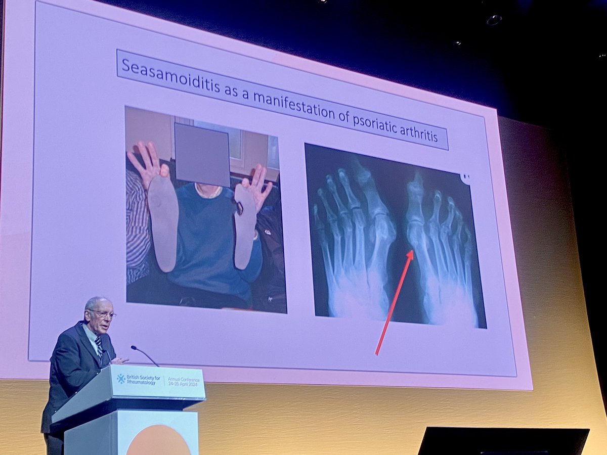 “Psoriasis is one of the most important bio markers in #rheumatology.” “Always examine the foot, especially for enthesitis.” “Dactylitis is more common in the foot than the hand. Other causes of dactylitis include gout, trauma and TB”. - Dr Phillip Helliwell #PsA #BSR24