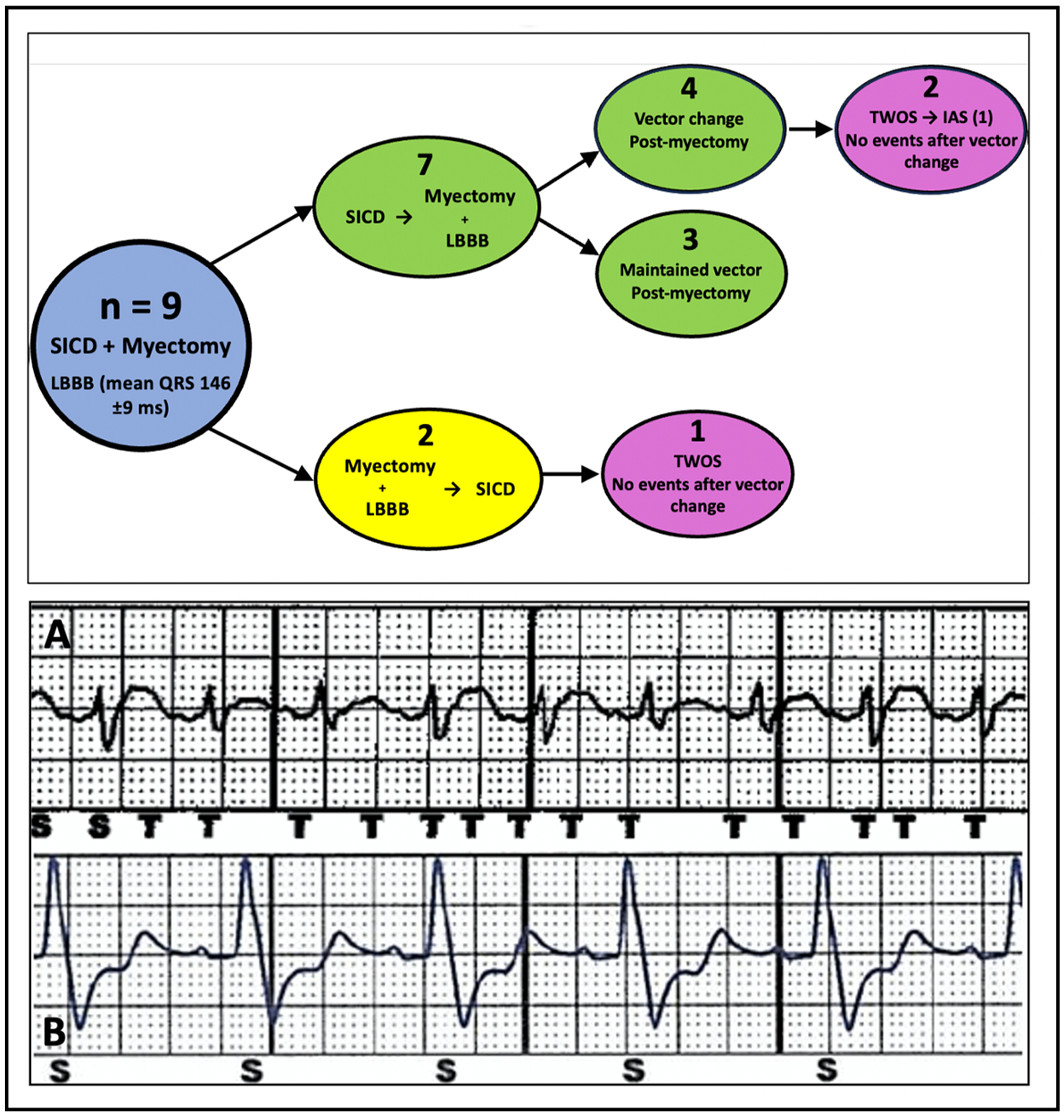 Maintenance of SICD in young patients with obstructive HCM who have undergone myectomy is advised given low rates of complications related to T‐wave oversensing & long‐term benefits of avoiding transvenous systems. #AHAJournals #ResearchLetter @EthanRowin ahajournals.org/doi/10.1161/JA…