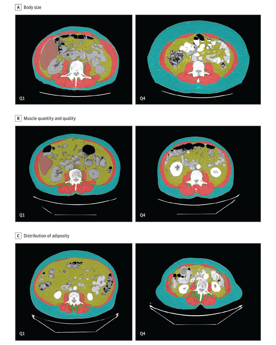 Most viewed in the last 7 days from @JAMASurgery: Can preoperative computed tomography scans provide patient frailty assessments that are associated with outcomes of abdominal surgery? ja.ma/4ddLAGu