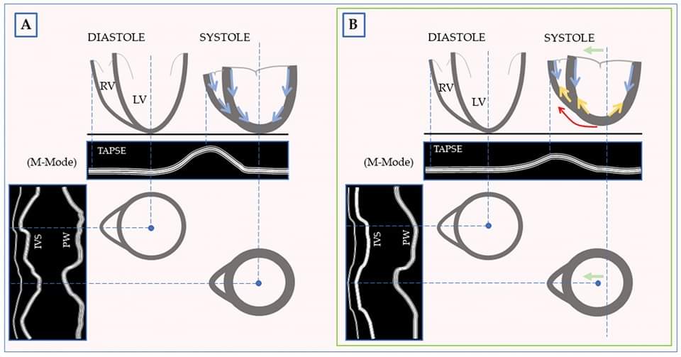 🔴 The Postoperative Paradoxical Septum (POPS): A Comprehensive Review on Physio-Pathological Mechanisms. #openaccess #2024Review 

mdpi.com/2077-0383/13/8…
 #CardioEd #Cardiology #MedEd #ENARM #cardiotwiteros #meded #cardiology #CardioTwitter #CardioEd #medtwitter