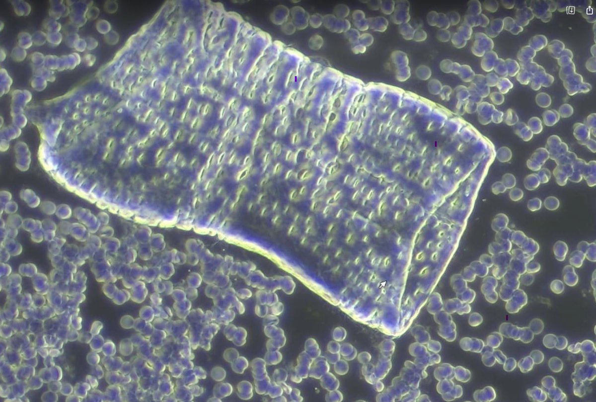 💥💥💥BREAKING!!!💥💥💥
The photo below is a micrograph of live blood under darkfield microscopy revealing a PEGulated synthetic hydrogel capsid or embodiment containing graphene oxide.. This technology was funded by DARPA and patented under US Patent 9,539,210 B2 January 2017.