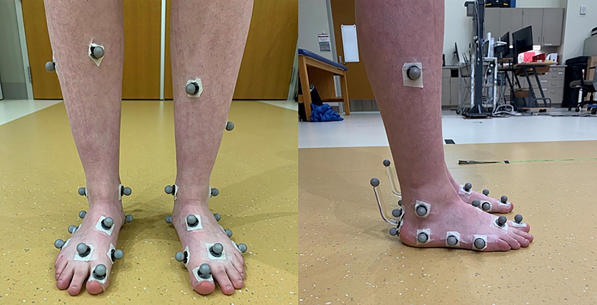 JBiomech's tweet photo. 😃New article published in J Biomech!

"Effects of different step lengths at a preferred walking speed on forefoot, midfoot, and hindfoot motion in healthy young adults", by Lovekin et al.

https://t.co/af5Iu3PTV9

#journalofbiomechanics https://t.co/GkQHcA5NsG
