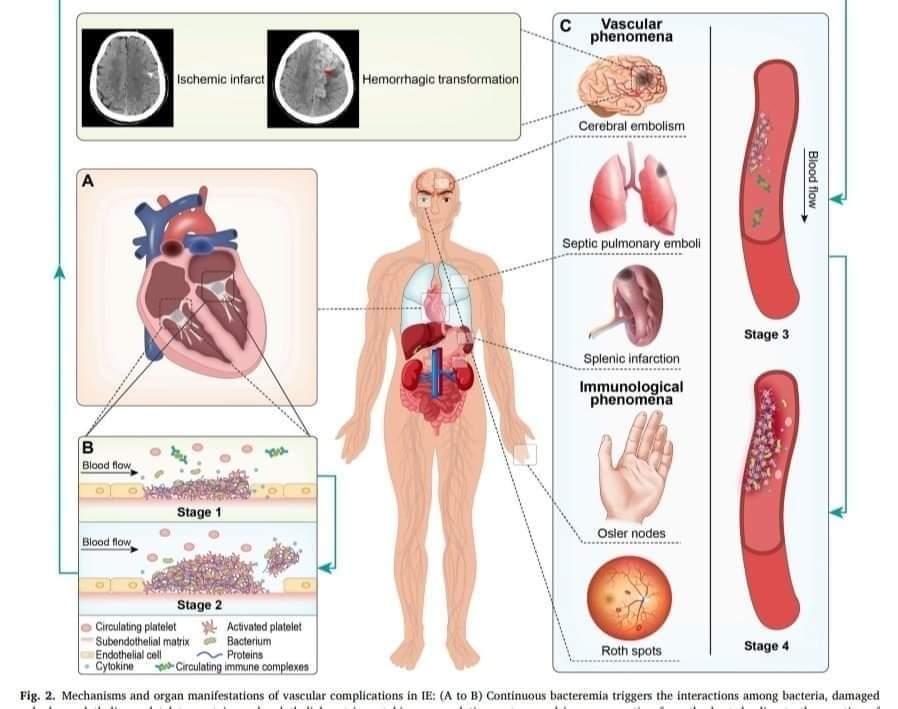 🔴 Management of anticoagulation in patients with infective endocarditis #2023review #openaccess 

thrombosisresearch.com/article/S0049-…
#cardiology #CardioTwitter #CardioEd
