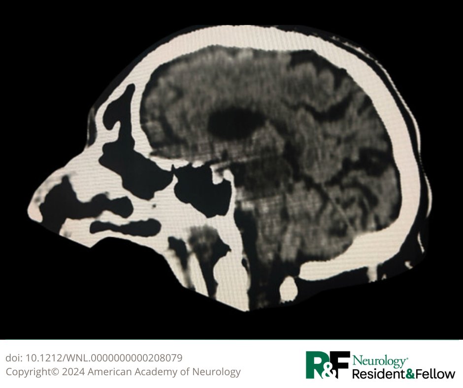 #NeuroTwitter: Take the latest #NeurologyRF Teaching NeuroImage quiz! An 82-yo man presented with acute right hemiparesis and confusion. In the next day, he evolved into coma and exhibited involuntary isolated tongue movements. Head CT revealed acute ischemic insults to the pons.