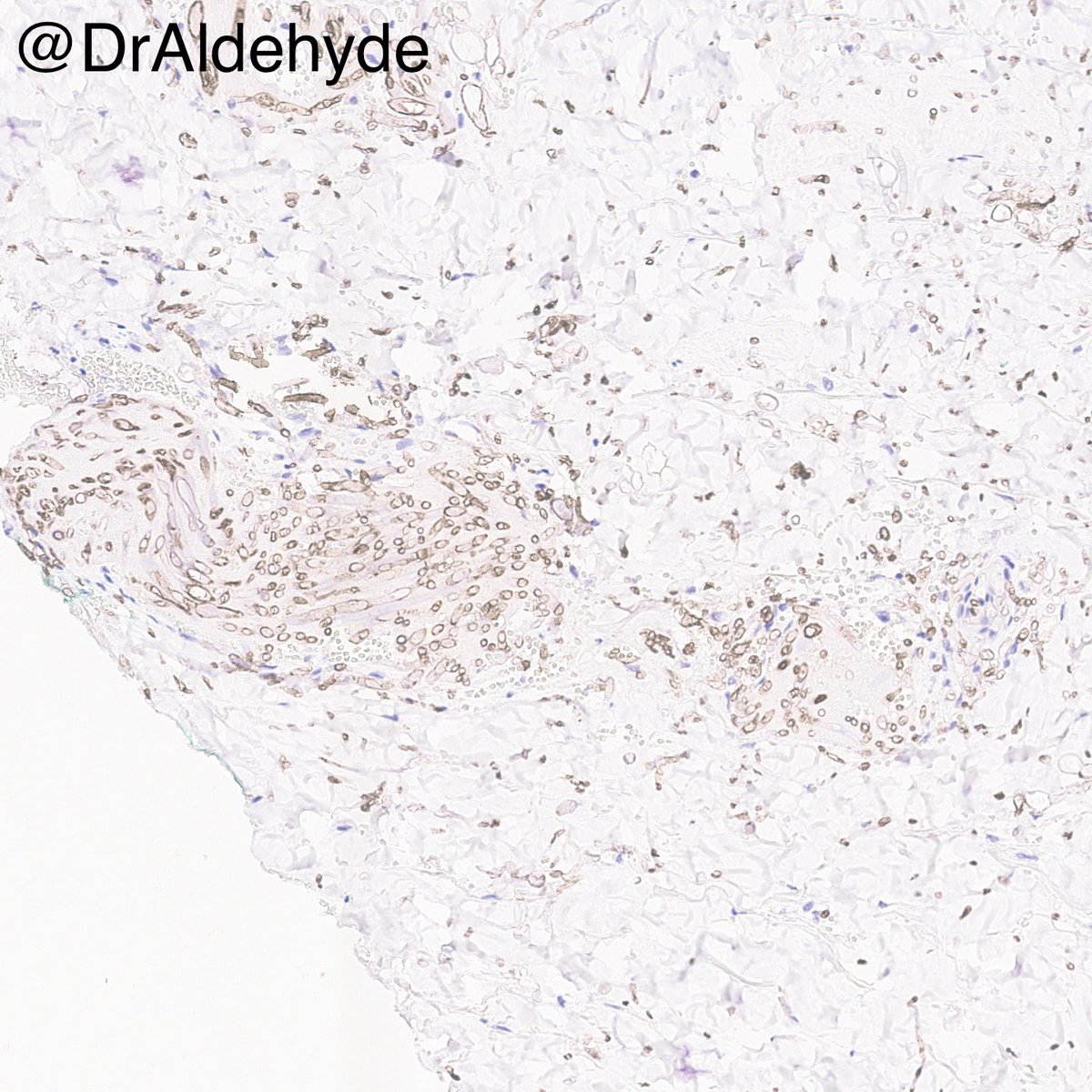 Any #dermpath lovers out there routinely use fusarium #IHCPath? My experience with this antibody has been great so far, and it helps me provide our treating physician team with the exact fungal species before the culture becomes available. #MDACCPath #pathology #microbiology