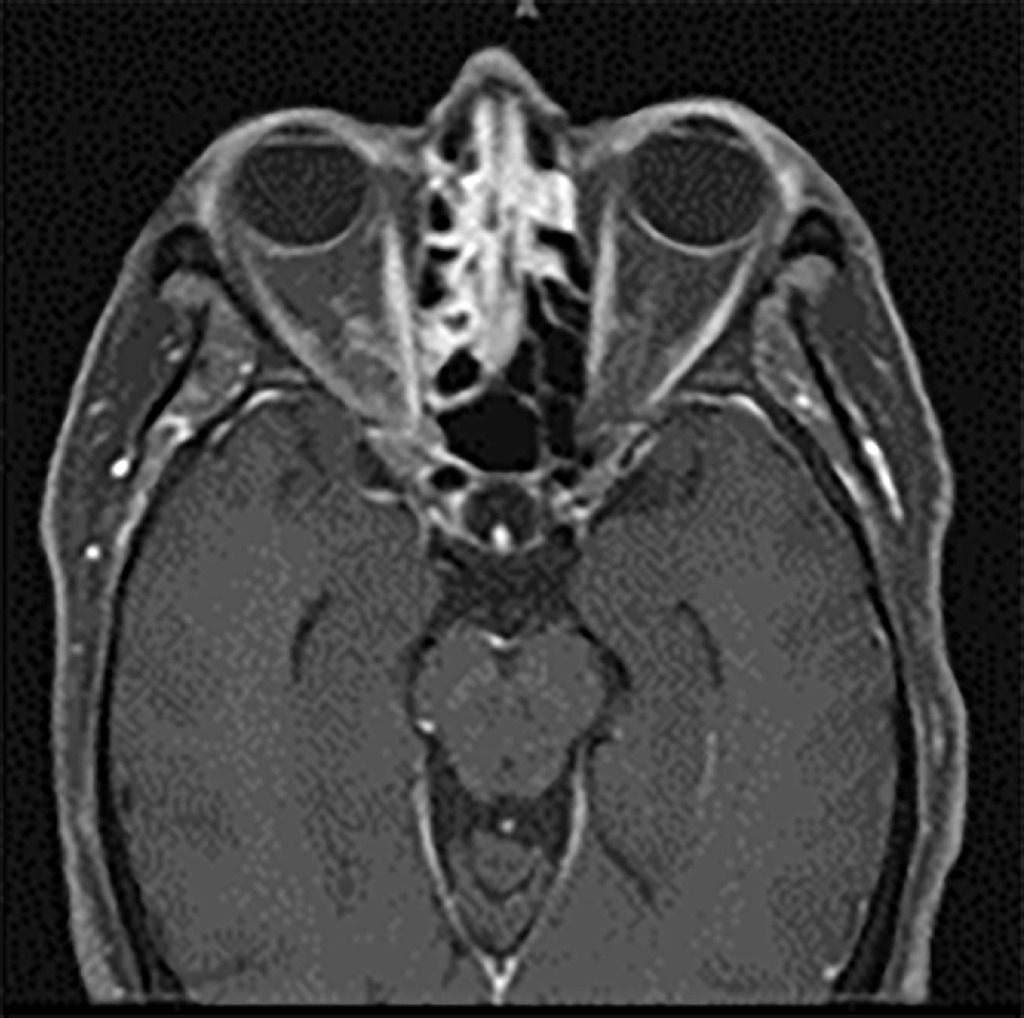 Isolated Cranial Nerve VI Palsy in #Granulomatosis With #Polyangiitis. Full text of this case report from @UNM is freely available at ow.ly/hGBa50RnqlN. @AHAScience @ACPIMPhysicians