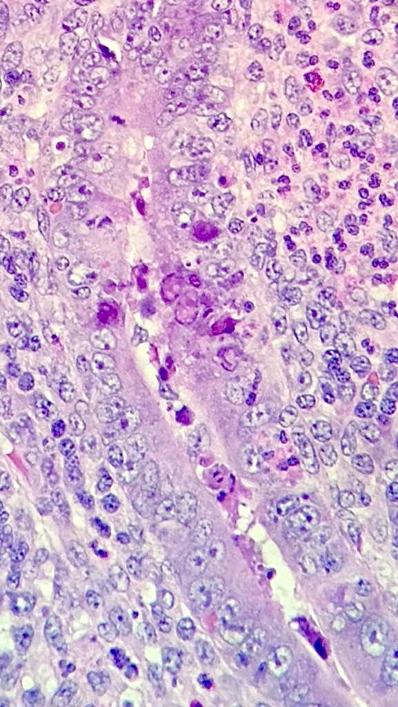 Two year old with Right Lower Quadrant pain, a URTI and conjunctivitis. A high power view of Adenovirus inclusion bodies in the appendix #PathX #PathTwitter