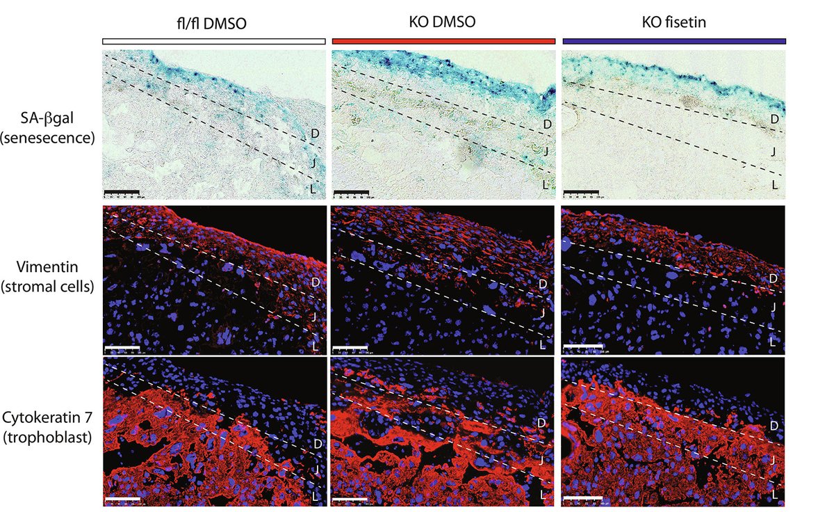 Why do some pregnant women develop #HeartFailure? 

New clinical research ties peripartum cardiomyopathy and preeclampsia to placental senescence, but shows that targeting activin A can mitigate heart damage in mice. @ScienceTM scim.ag/6Ix