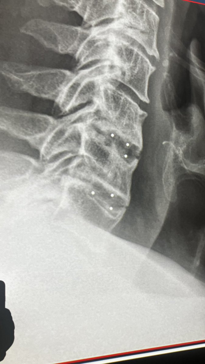 my attending said that the amount of subsidence was 50% of height in the lower and 90% in the upper segment and I think it’s pretty accurate. And we discussed the metal markers in PEEK cages and how to deal with them… 🤔 … it’s not just an upsidedown issue, isn’t it?