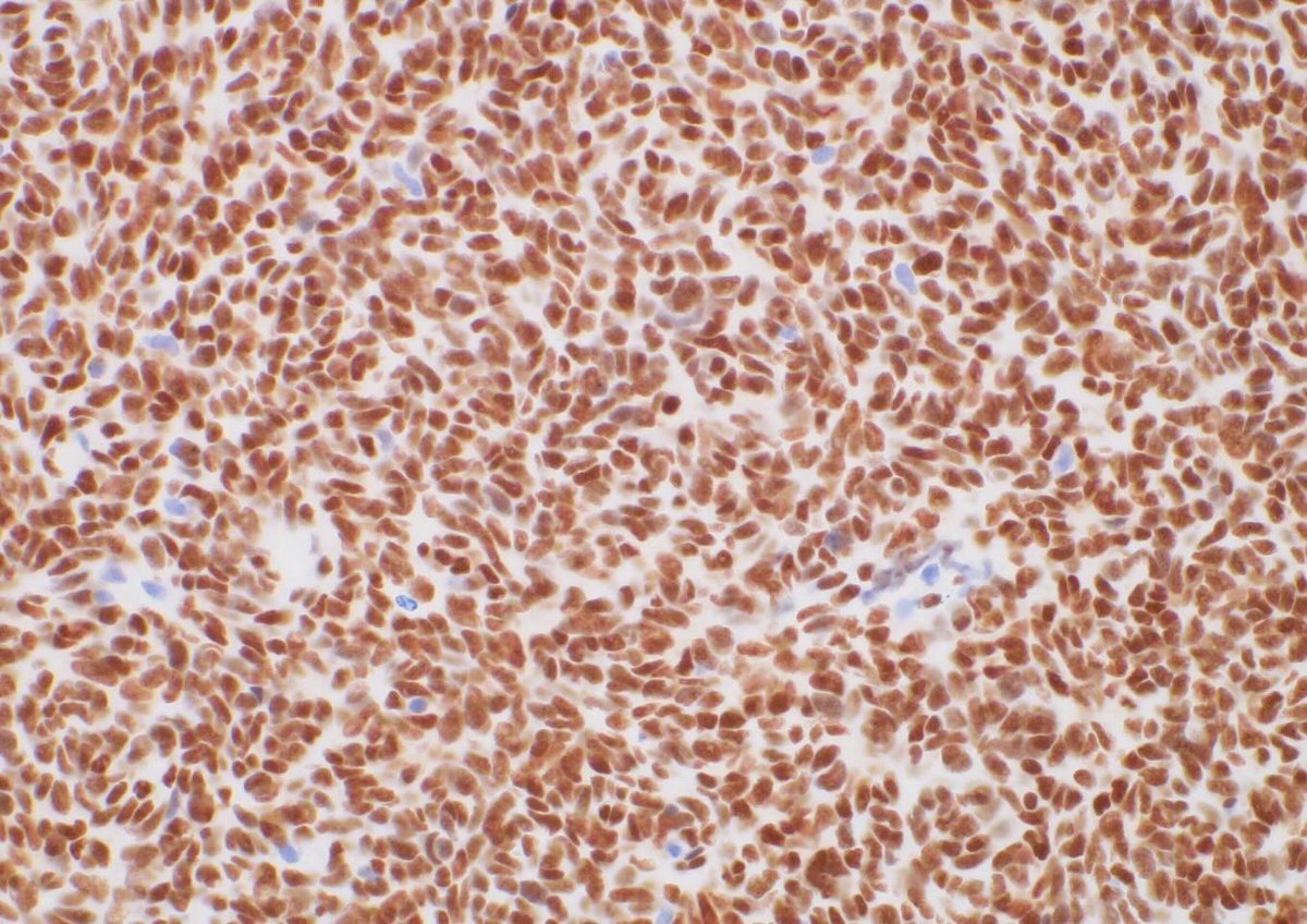 Solitary fibrous tumor (hemangiopericytoma) of cranial dura. Note the patternless pattern, or swimming fish appearance. 1. Watercolor on paper 2. H&E 3. STAT6 #neuropath #neuropathology #neurosurgery #neuroradiology #pathart