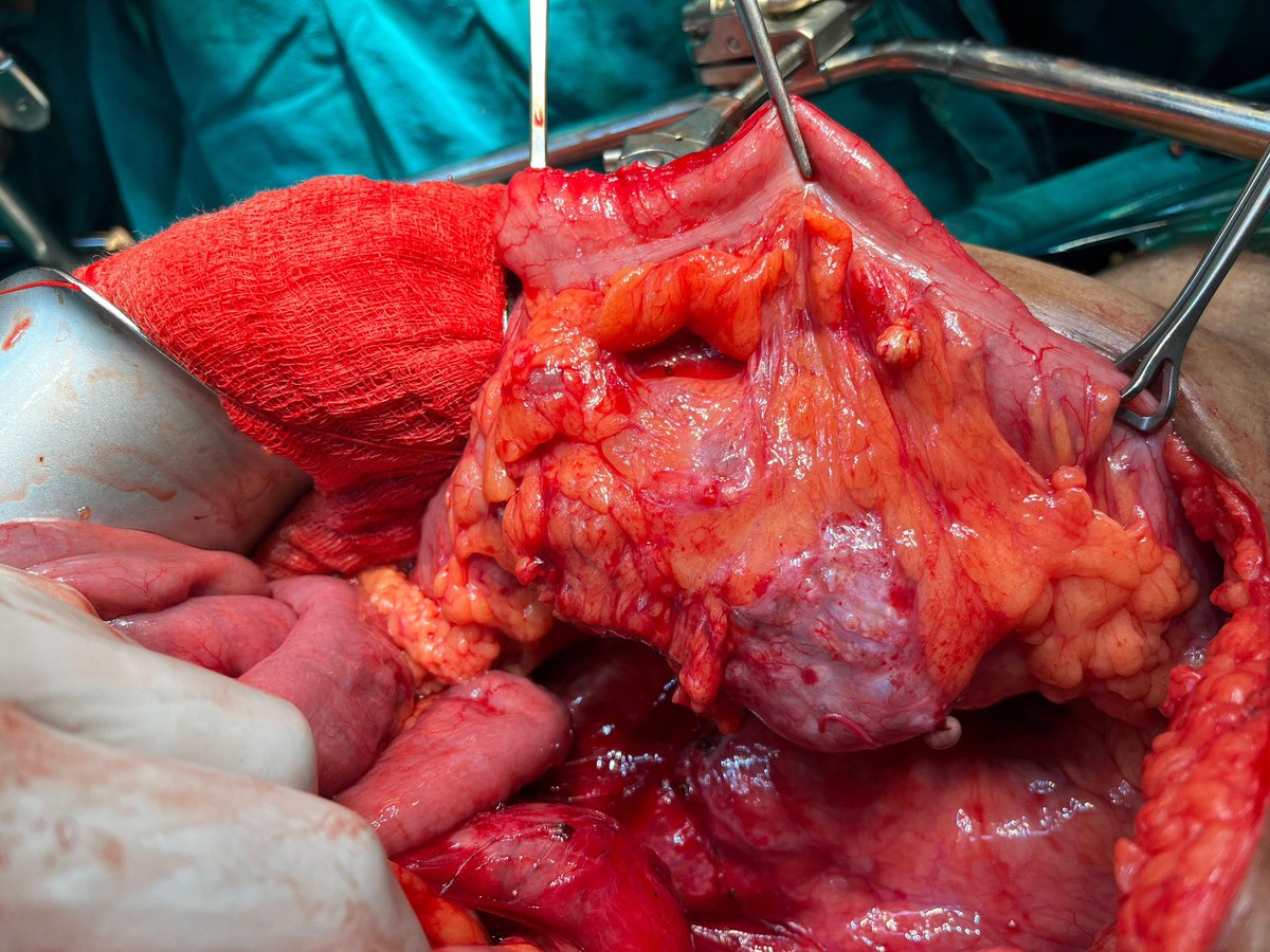 TCa D24
Most common auxiliary procedure for a RPLND is a nephrectomy

Sometimes, the masses have unusual locations 

Couple of days back, we had this nice round mass sitting within the sigmoid mesocolon!! Needed a segmental resection

Any similar experience??