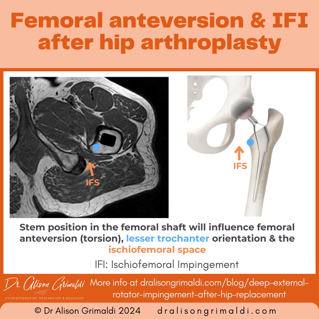 During total hip arthroplasty, the positioning of the prosthetic stem in the femoral shaft will influence femoral anteversion & the ischiofemoral space. Excessive anteversion may give rise to #IFI . Read more in the blog: dralisongrimaldi.com/blog/deep-exte… #THA #hipsurgery #buttockpain