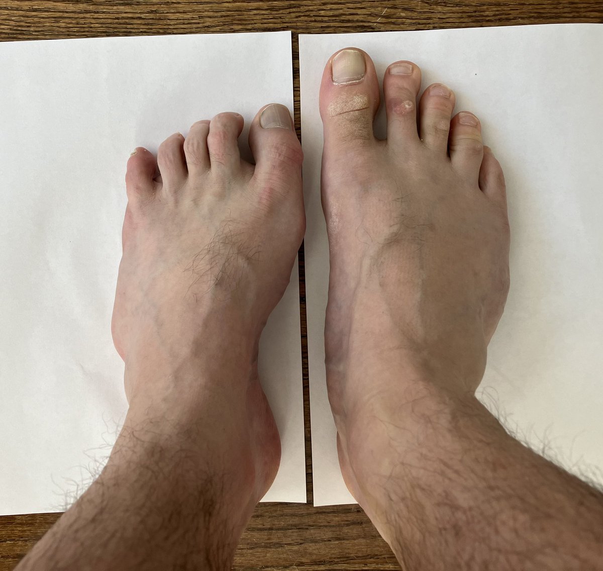 I have a little foot. It causes me lots of pain, and for the last week it’s been injured. I needed an X-Ray, so I called the Xray Department at the hospital in my town, to see if the X-Ray tech would mind wearing a mask for the time it took to adjust my foot for the X-Rays.